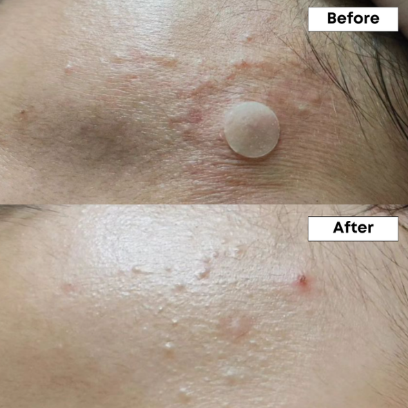 NINELESS - A-Control 10% Azelaic Acid Serum 30ml