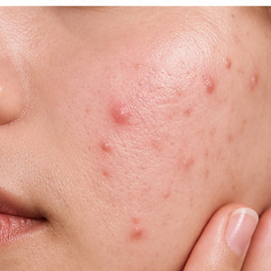 Acne & Breakouts