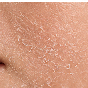 Dehydrated & Flaky Skin