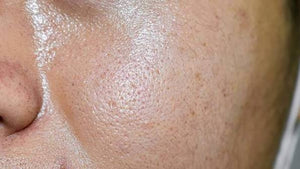 Excess Oil & Sebum