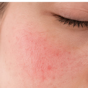 Redness & Irritation